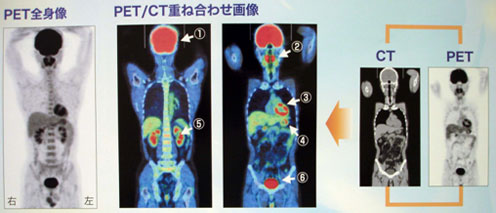 PET-CT検査2